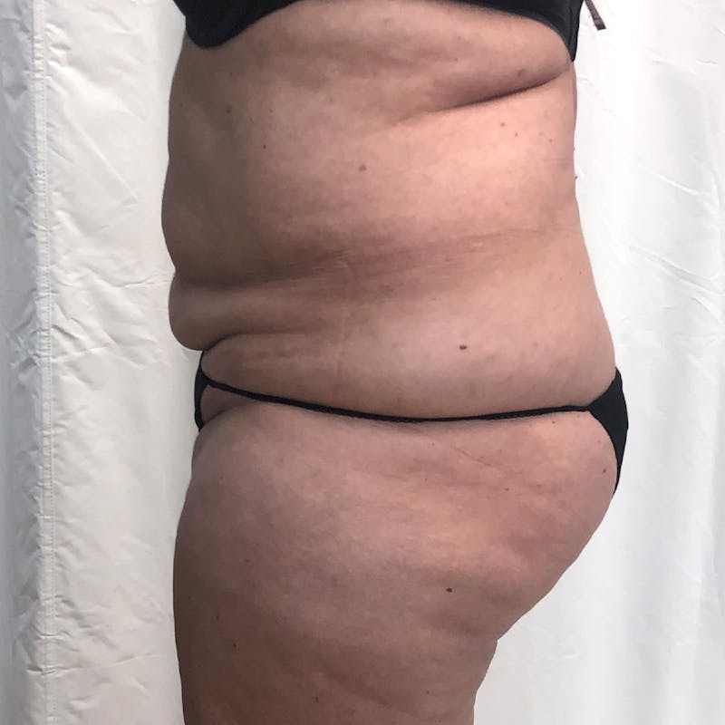 Tummy Tuck Before & After Gallery - Patient 327699 - Image 5