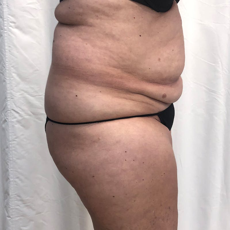 Tummy Tuck Before & After Gallery - Patient 327699 - Image 3