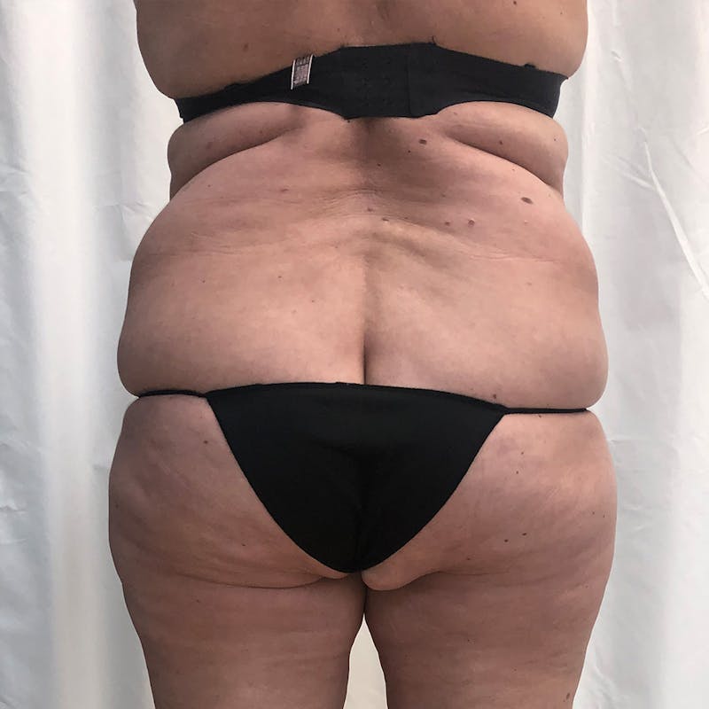 Tummy Tuck Before & After Gallery - Patient 327699 - Image 7