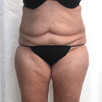 Tummy Tuck Before & After Gallery - Patient 327699 - Image 1