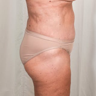Tummy Tuck Before & After Gallery - Patient 327699 - Image 4