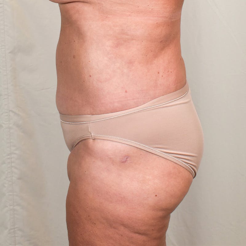 Tummy Tuck Before & After Gallery - Patient 327699 - Image 6