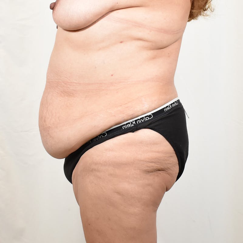 Tummy Tuck Before & After Gallery - Patient 322131 - Image 5