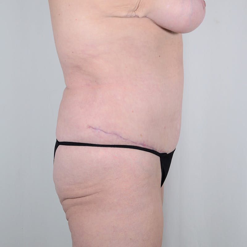 Tummy Tuck Before & After Gallery - Patient 156798 - Image 4