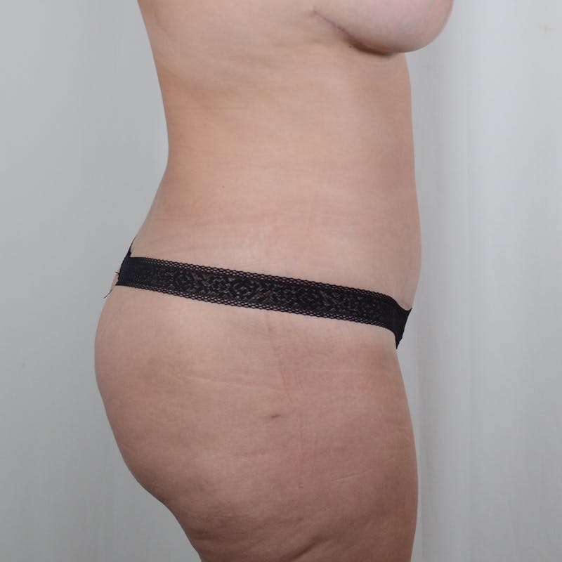 Tummy Tuck Before & After Gallery - Patient 342553 - Image 4
