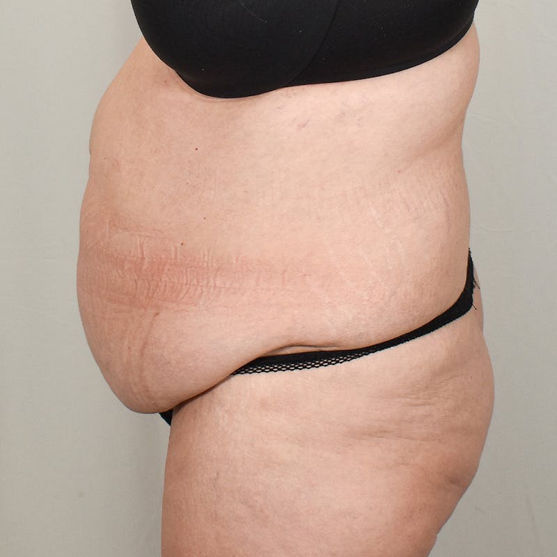 Tummy Tuck Before & After Gallery - Patient 424397 - Image 5