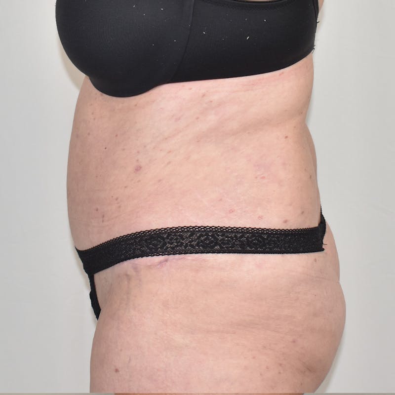 Tummy Tuck Before & After Gallery - Patient 424397 - Image 6