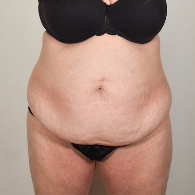 Tummy Tuck Before & After Gallery - Patient 424397 - Image 1