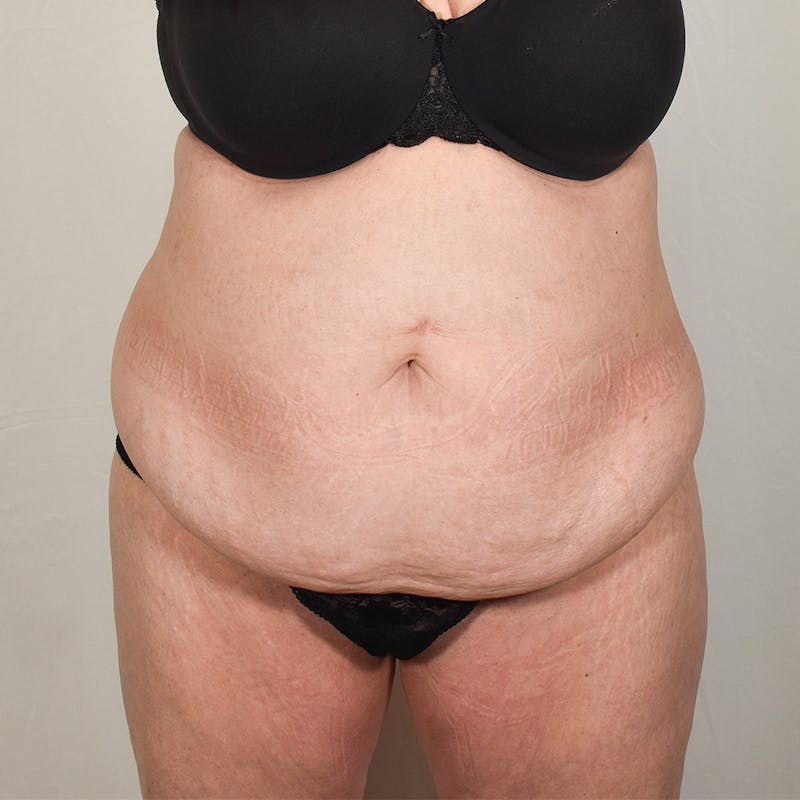 Tummy Tuck Before & After Gallery - Patient 424397 - Image 1