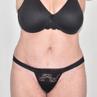 Tummy Tuck Before & After Gallery - Patient 424397 - Image 2