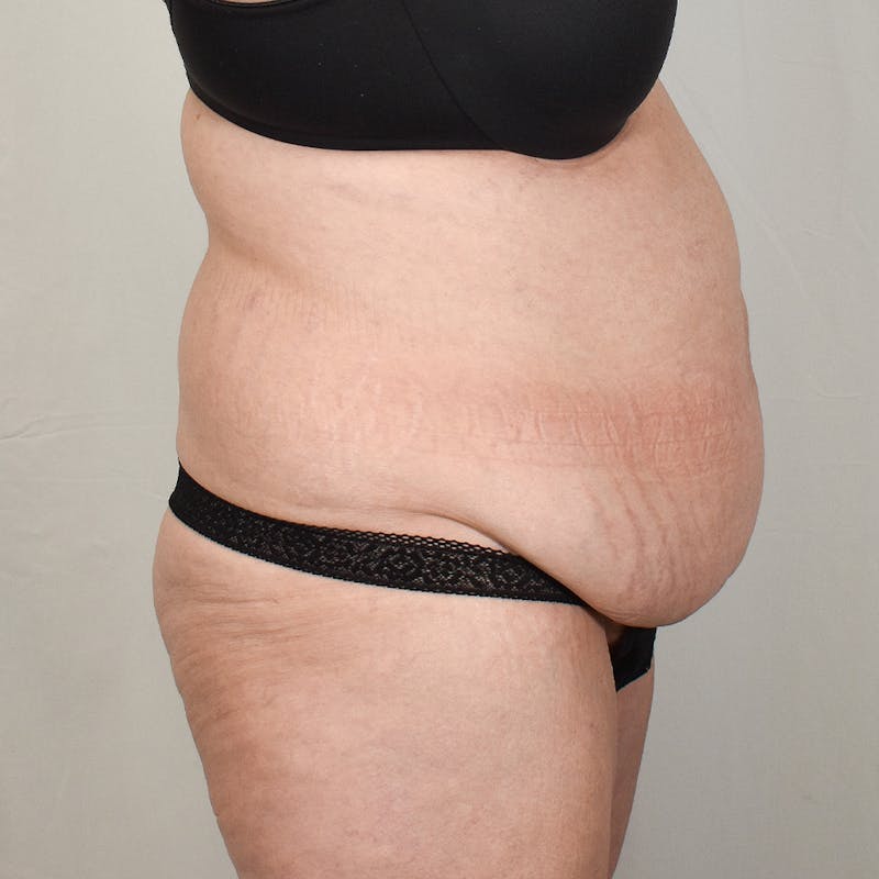 Tummy Tuck Before & After Gallery - Patient 424397 - Image 3