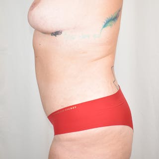 Tummy Tuck Before & After Gallery - Patient 786473 - Image 6