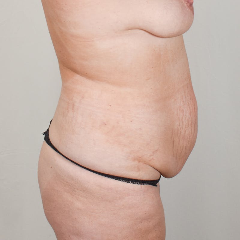 Tummy Tuck Before & After Gallery - Patient 786473 - Image 3