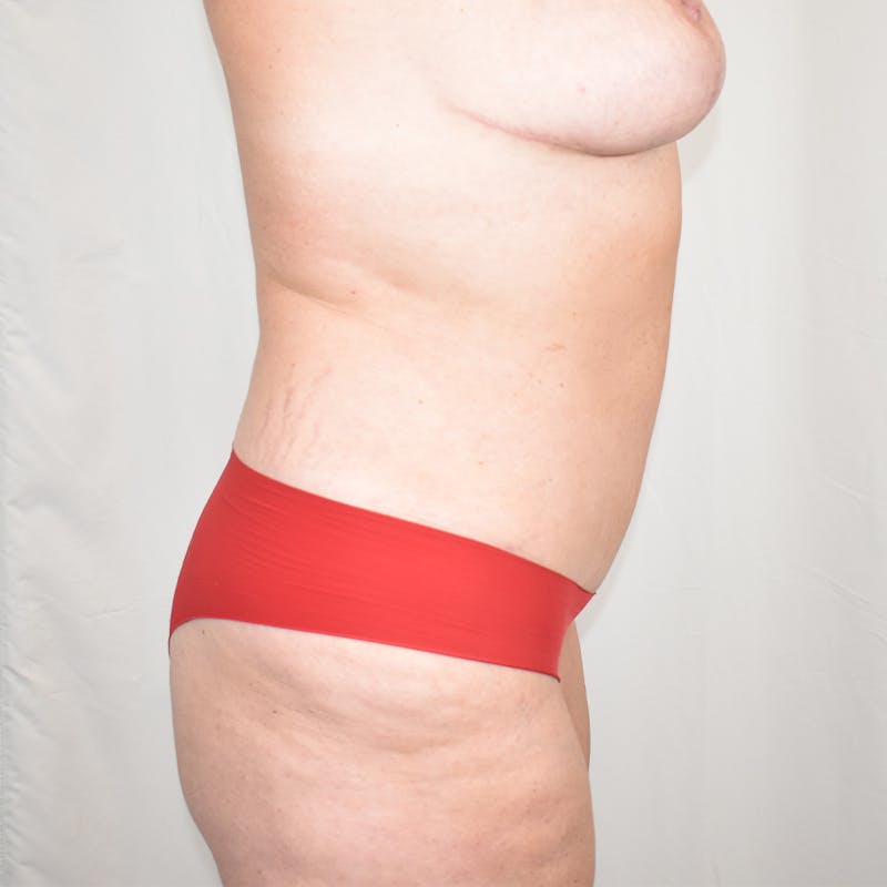 Tummy Tuck Before & After Gallery - Patient 786473 - Image 4