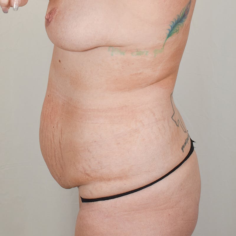 Tummy Tuck Before & After Gallery - Patient 786473 - Image 5