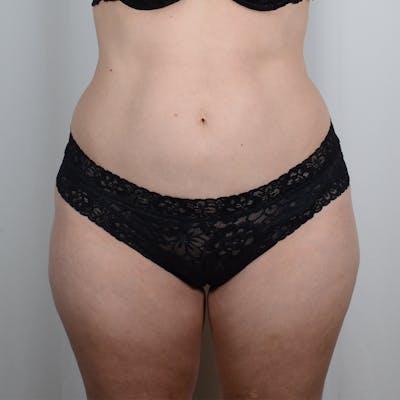 Tummy Tuck Before & After Gallery - Patient 893535 - Image 1