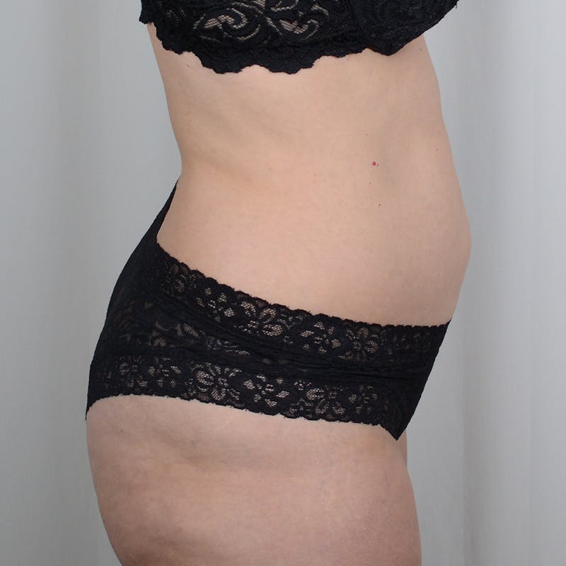 Tummy Tuck Before & After Gallery - Patient 893535 - Image 3
