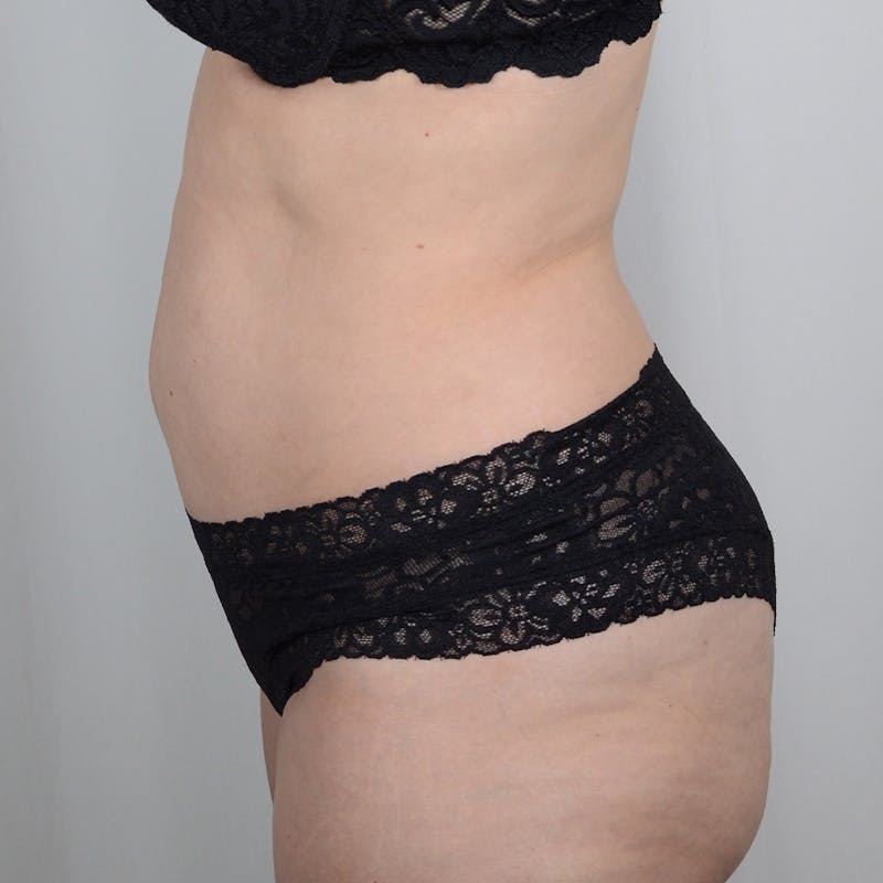 Tummy Tuck Before & After Gallery - Patient 893535 - Image 5