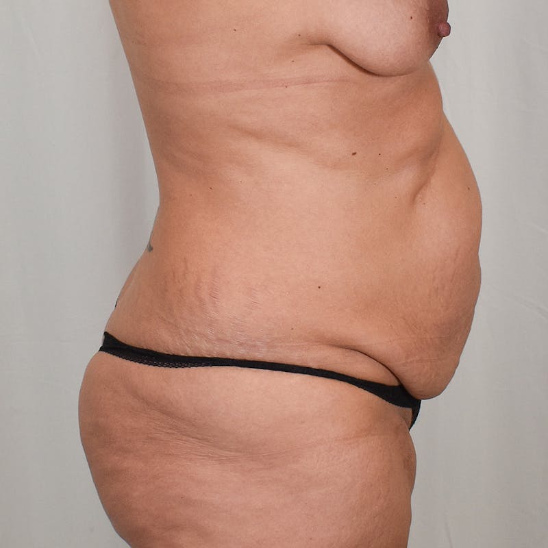 Tummy Tuck Before & After Gallery - Patient 177814 - Image 3