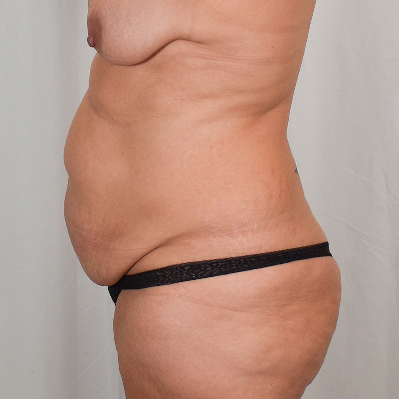 Tummy Tuck Before & After Gallery - Patient 177814 - Image 5