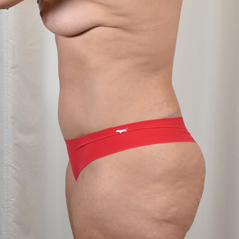 Tummy Tuck Before & After Gallery - Patient 177814 - Image 6