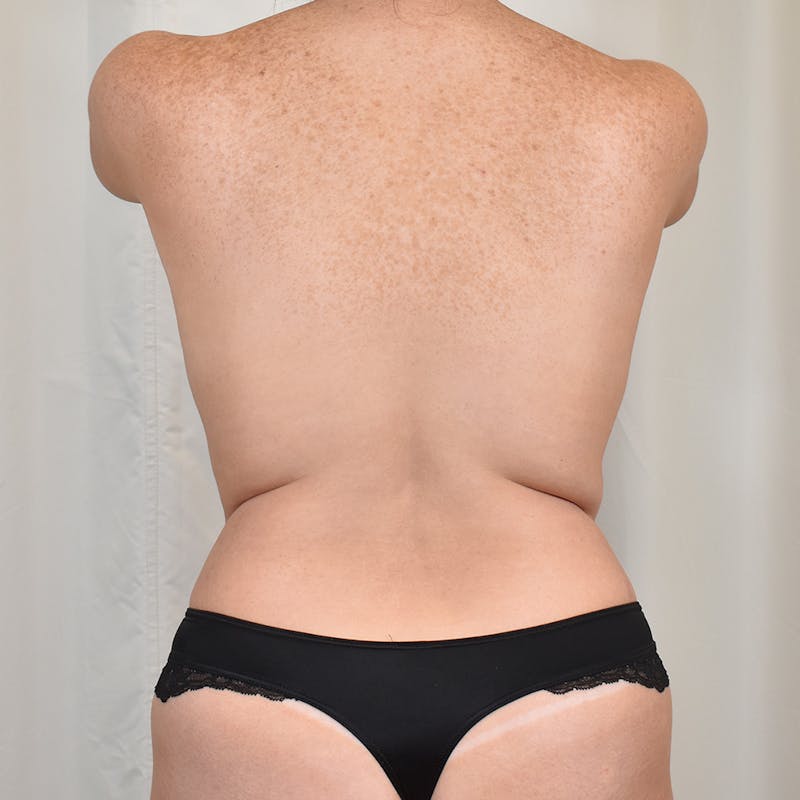 Tummy Tuck Before & After Gallery - Patient 289999 - Image 8