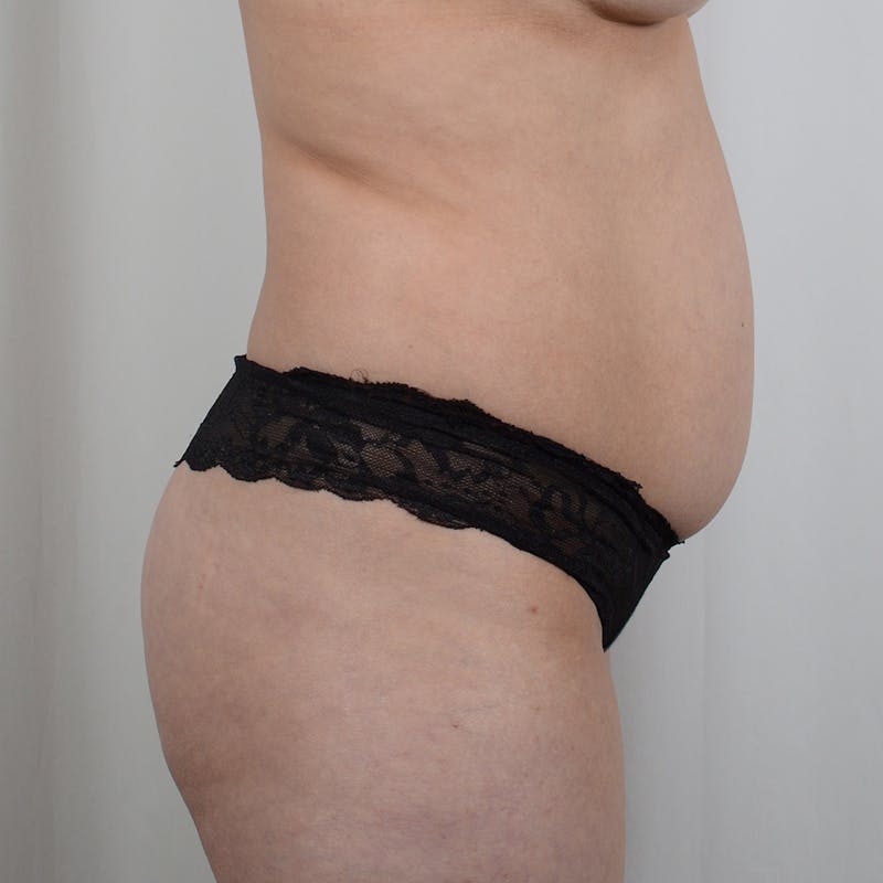 Tummy Tuck Before & After Gallery - Patient 854013 - Image 3