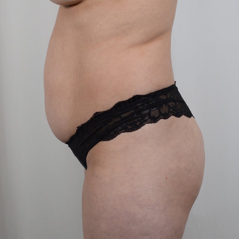 Tummy Tuck Before & After Gallery - Patient 854013 - Image 5