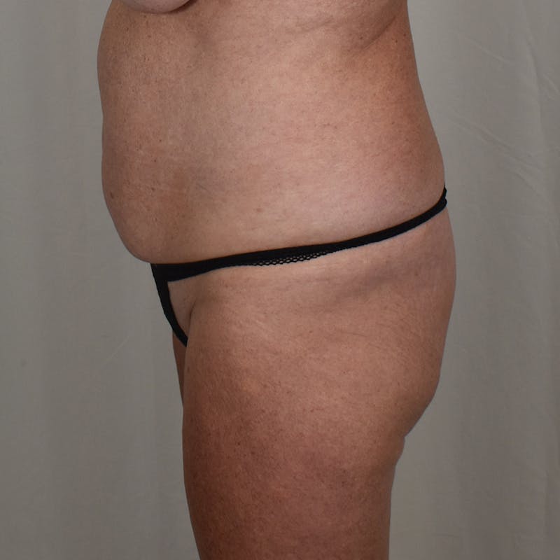 Tummy Tuck Before & After Gallery - Patient 391318 - Image 5