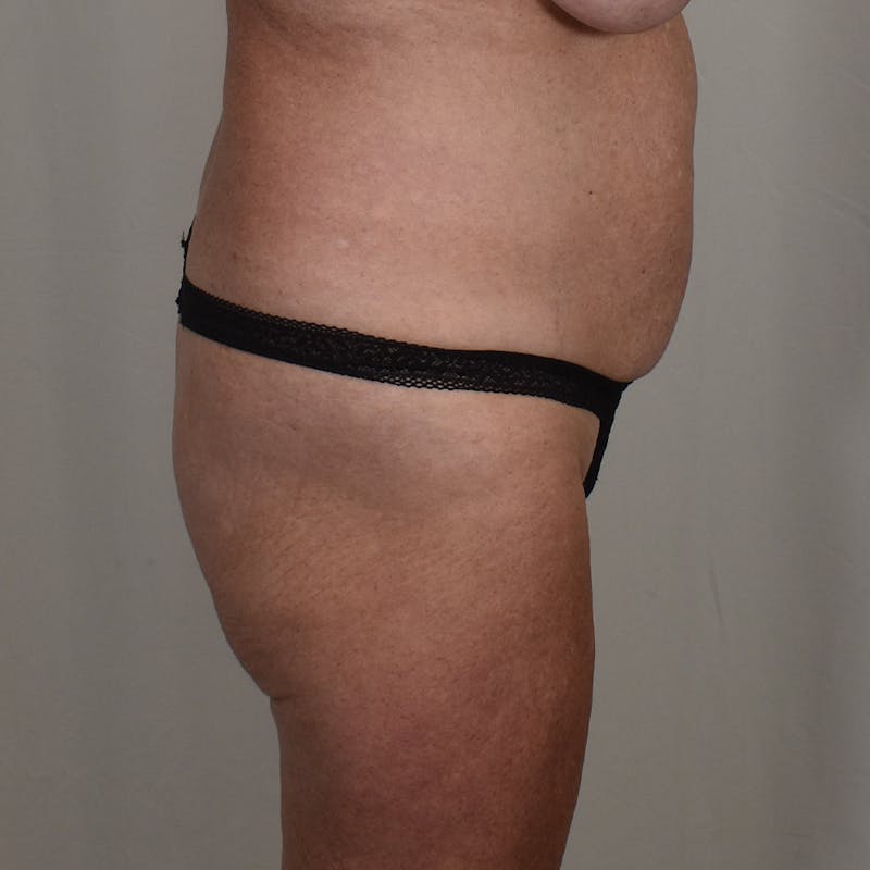 Tummy Tuck Before & After Gallery - Patient 391318 - Image 3