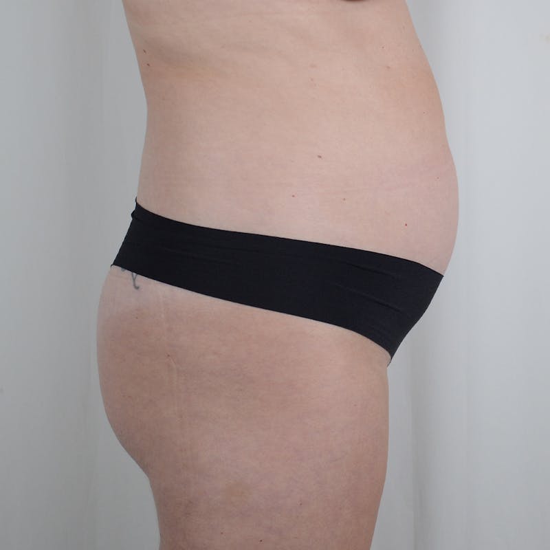 Tummy Tuck Before & After Gallery - Patient 377714 - Image 3