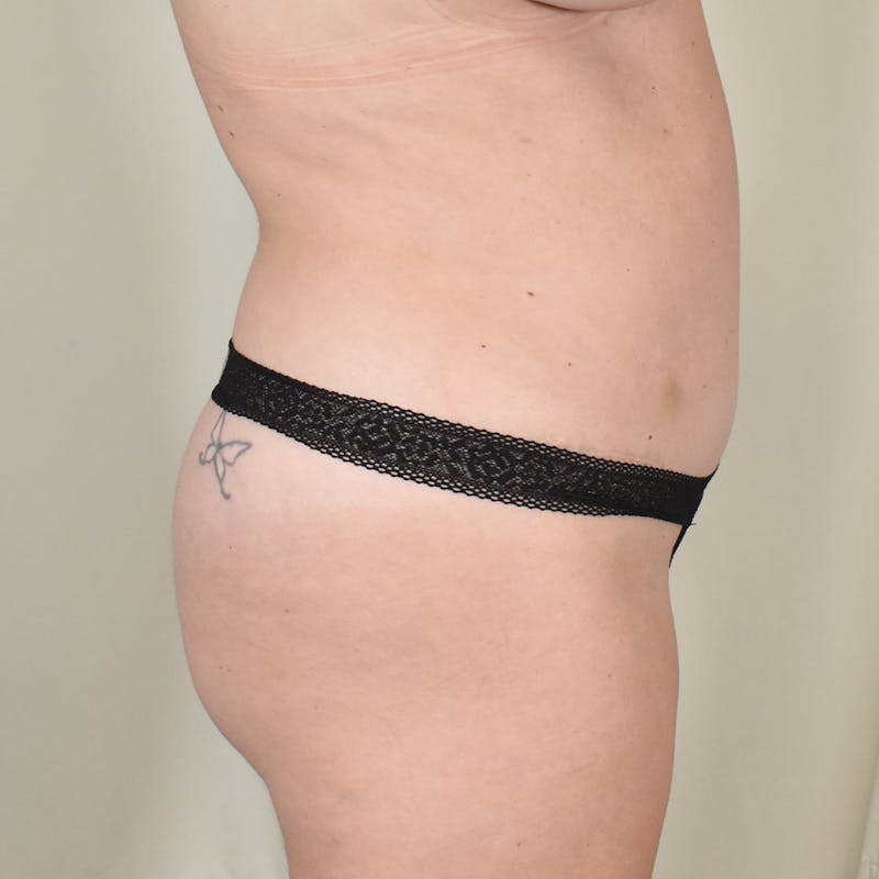 Tummy Tuck Before & After Gallery - Patient 377714 - Image 4