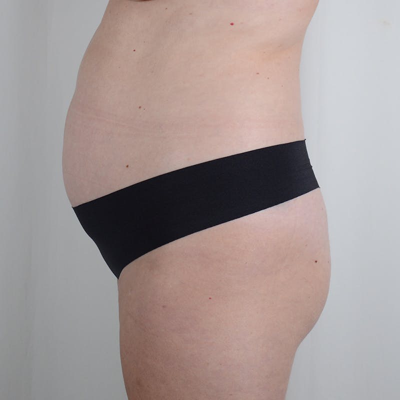 Tummy Tuck Before & After Gallery - Patient 377714 - Image 5