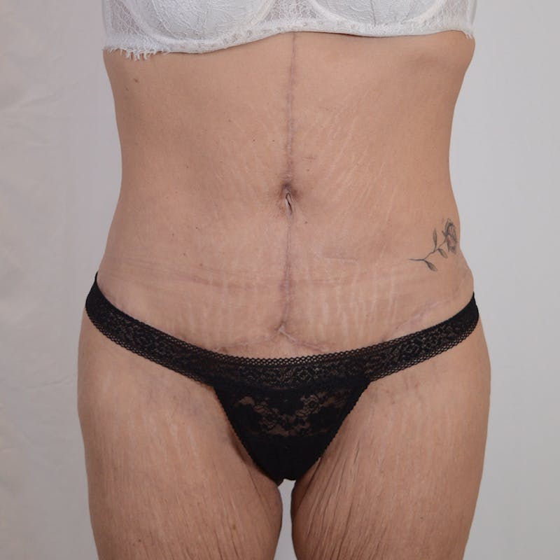 Tummy Tuck Before & After Gallery - Patient 101429 - Image 2