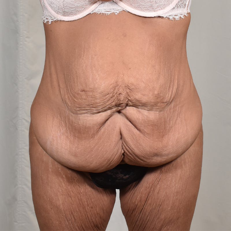 Tummy Tuck Before & After Gallery - Patient 101429 - Image 1