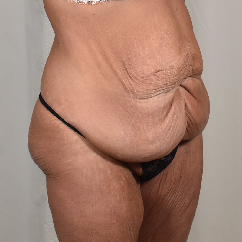 Tummy Tuck Before & After Gallery - Patient 101429 - Image 3