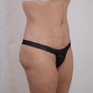 Tummy Tuck Before & After Gallery - Patient 101429 - Image 4