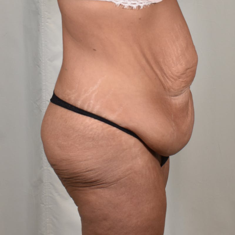 Tummy Tuck Before & After Gallery - Patient 101429 - Image 5