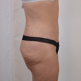Tummy Tuck Before & After Gallery - Patient 101429 - Image 6