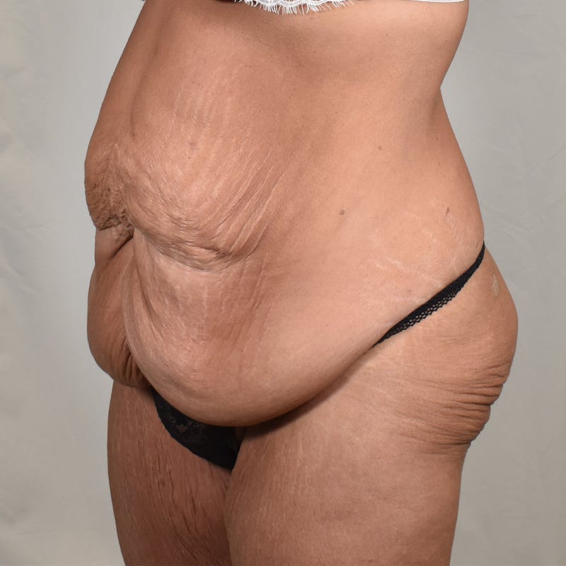 Tummy Tuck Before & After Gallery - Patient 101429 - Image 7