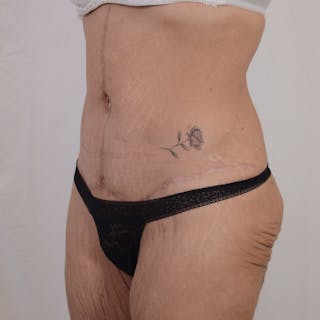 Tummy Tuck Before & After Gallery - Patient 101429 - Image 8