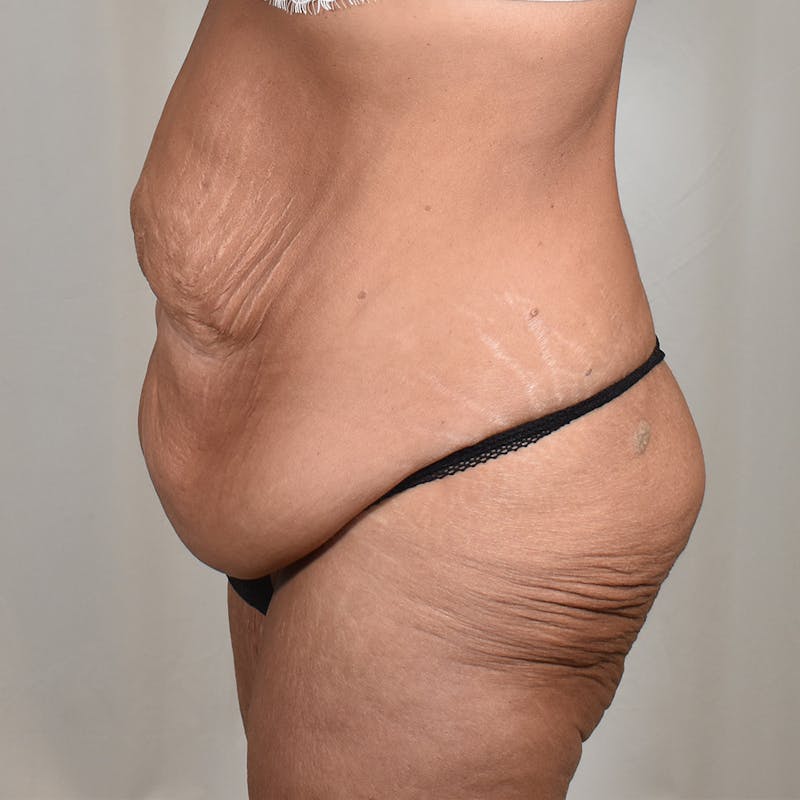 Tummy Tuck Before & After Gallery - Patient 101429 - Image 9