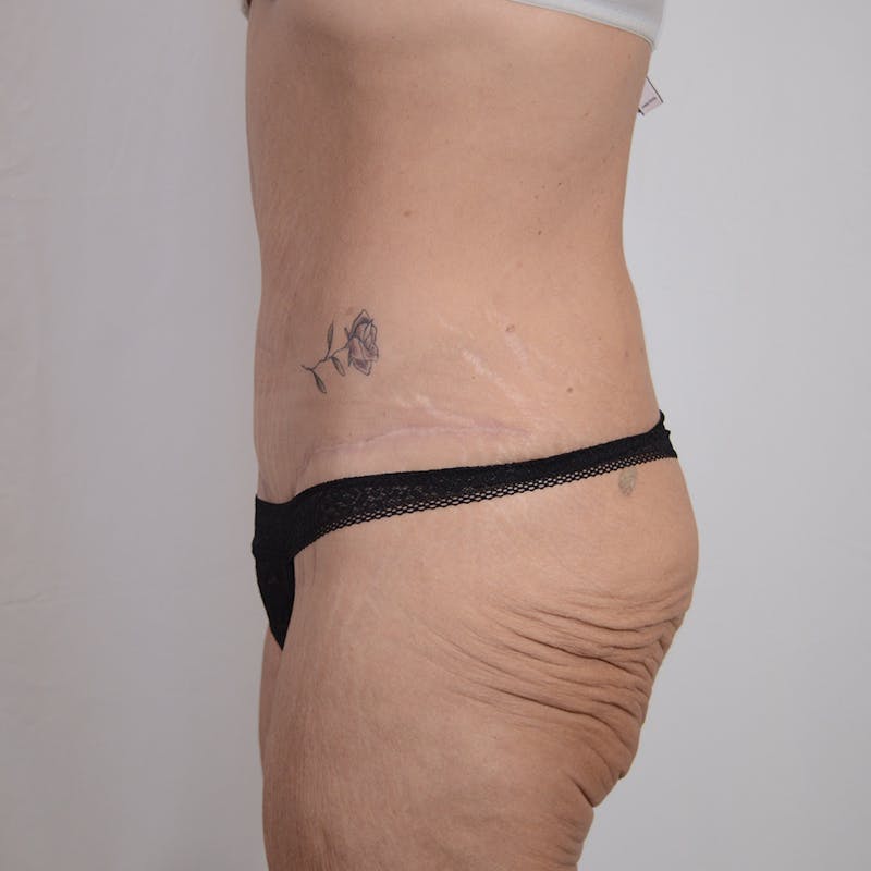 Tummy Tuck Before & After Gallery - Patient 101429 - Image 10