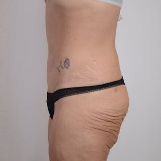 Tummy Tuck Before & After Gallery - Patient 101429 - Image 10