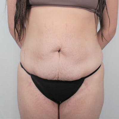 Tummy Tuck Before & After Gallery - Patient 242761 - Image 1