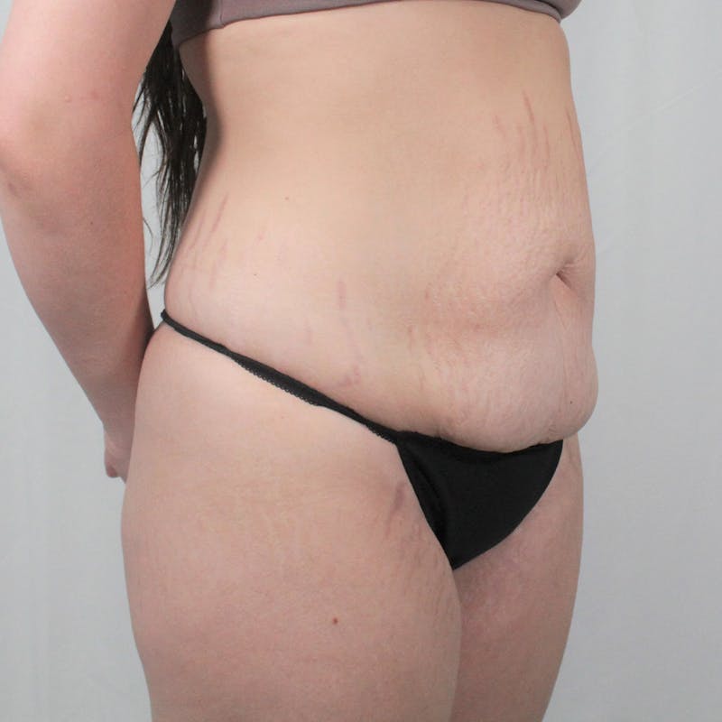 Tummy Tuck Before & After Gallery - Patient 242761 - Image 3