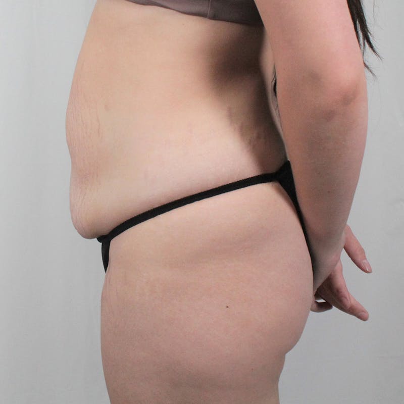 Tummy Tuck Before & After Gallery - Patient 242761 - Image 9