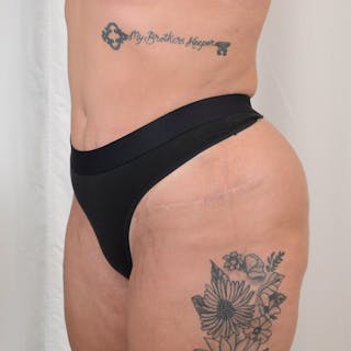 Tummy Tuck Before & After Gallery - Patient 215219 - Image 8