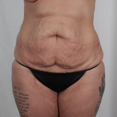 Tummy Tuck Before & After Gallery - Patient 215219 - Image 1