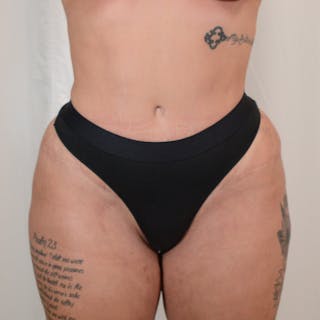 Tummy Tuck Before & After Gallery - Patient 215219 - Image 2